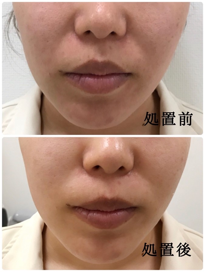 ハイフ(HIFU、高密度焦点式超音波) ウルトラセルQ＋ 1回の効果 | つか