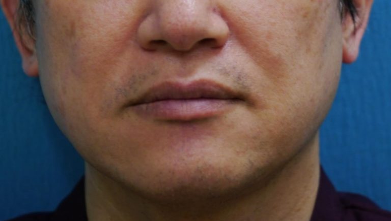 髭脱毛【医療レーザー脱毛】の6年後の効果は？？ | つかはら ...