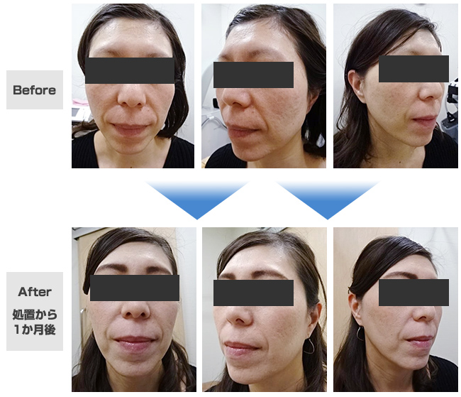 HIFU（ウルトラセルQ＋）+ 小顔ボトックス注射治療症例