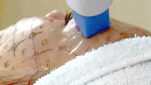 テスト照射・サーマクール本照射開始